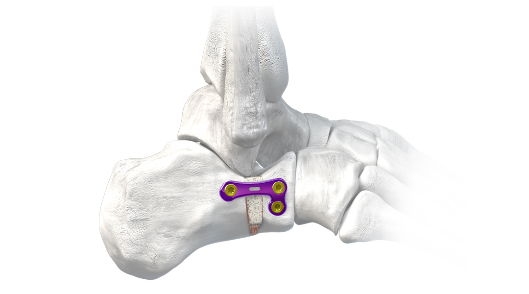 Orb Medical | Gorilla® Plating System