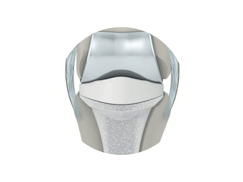 Orb Medical | Proximal Interphalangeal Replacement™