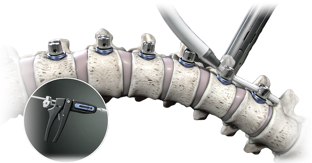 The Tether™ Vertebral Body Tethering System | Orb Medical