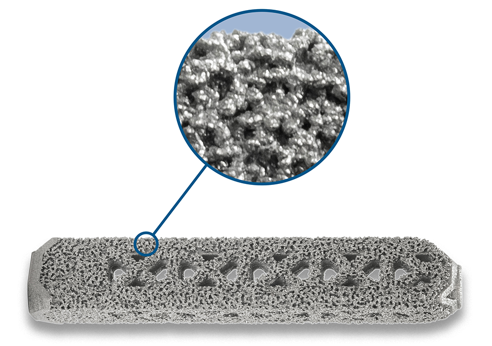 Orb Medical | iFuse Implant System®