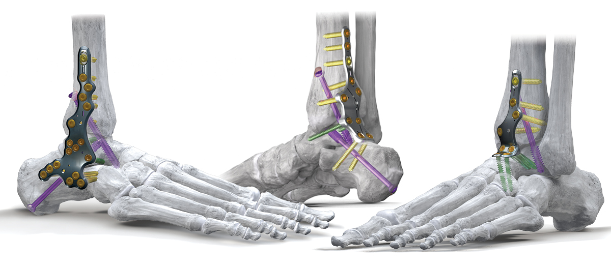 Orb Medical | Silverback™ Ankle Fusion Plating System