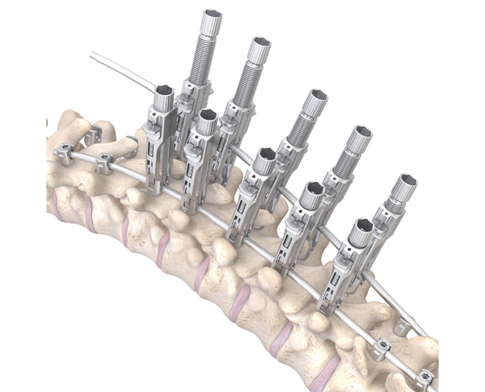 Orb Medical | OrthoPediatrics Spine