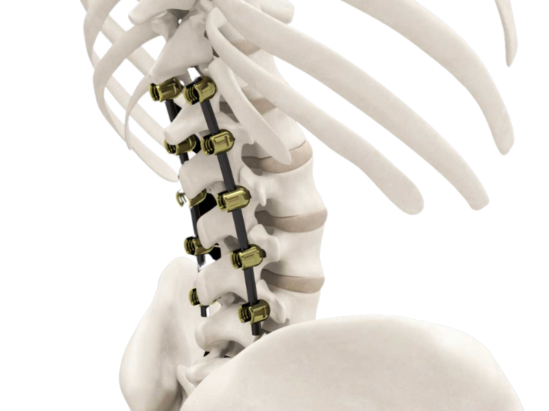 Orb Medical | icotec Pedicle Systems
