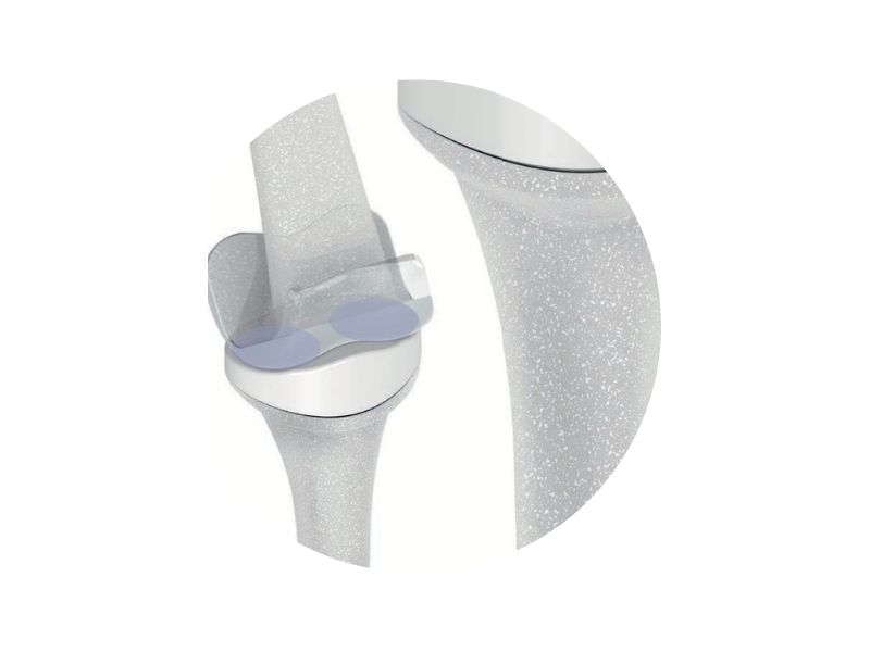 Orb Medical | Proximal Interphalangeal Replacement™