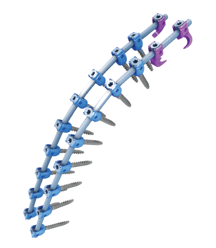 Orb Medical | Vital™ Deformity Spinal Fixation System