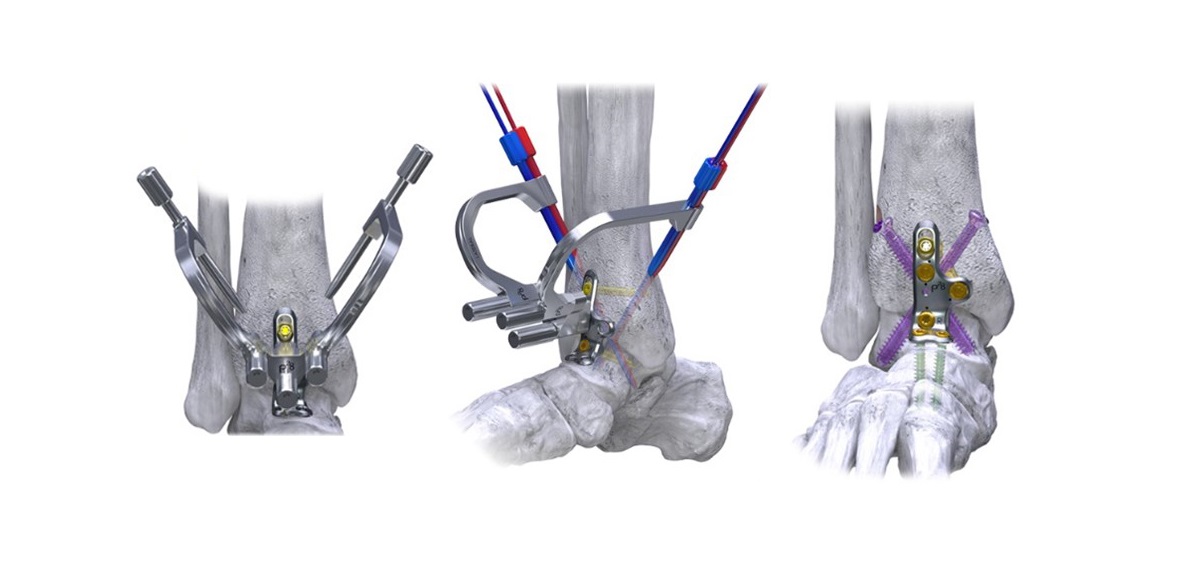 Orb Medical | Silverback™ Ankle Fusion Plating System