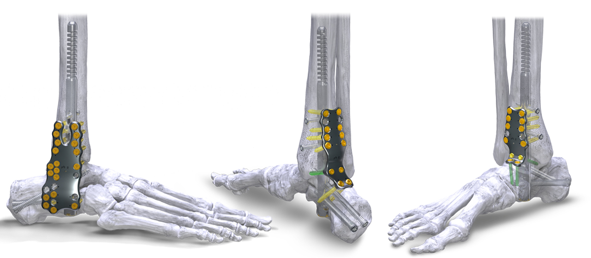 Orb Medical | Silverback™ Ankle Fusion Plating System