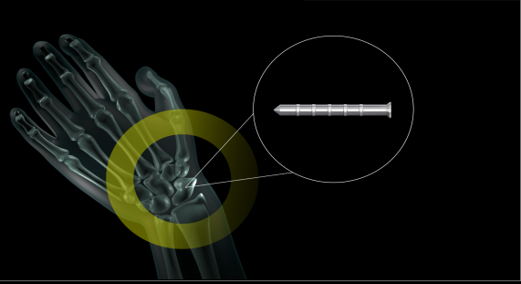 Orb Medical | MAGNEZIX® Bio-resorbable Pins and Compression Screws