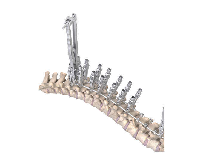 Orb Medical | OrthoPediatrics Spine